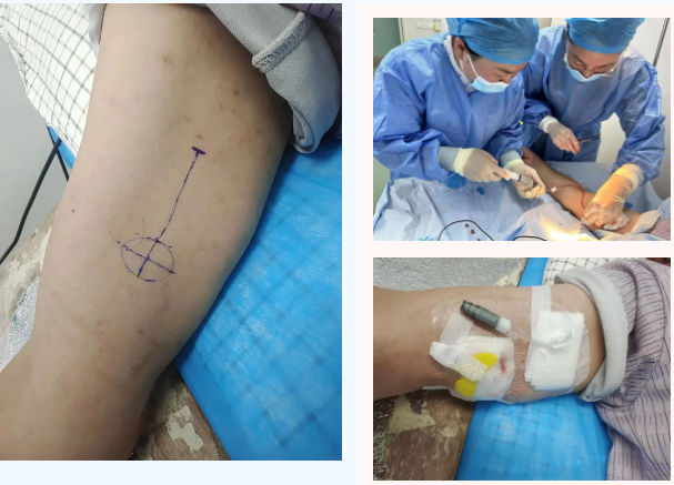 藏于臂弯里的生命港医院成功开展首例上臂输液港置入术